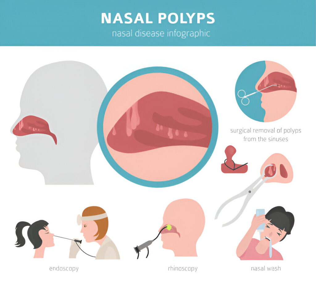 Nasal Polyps