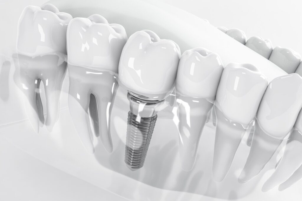 Dental Implants