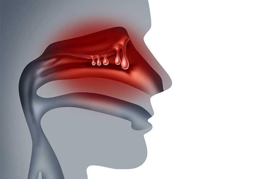 Nasal Polyps